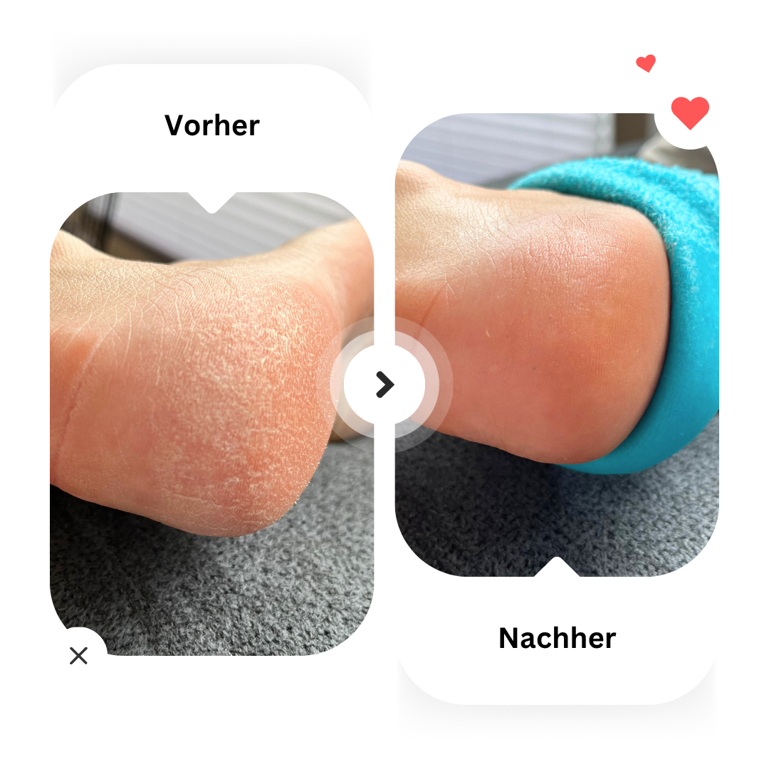 Vorher-Nachher-Vergleich: Verbesserte Hautstruktur durch Hydra Fersen Socken.