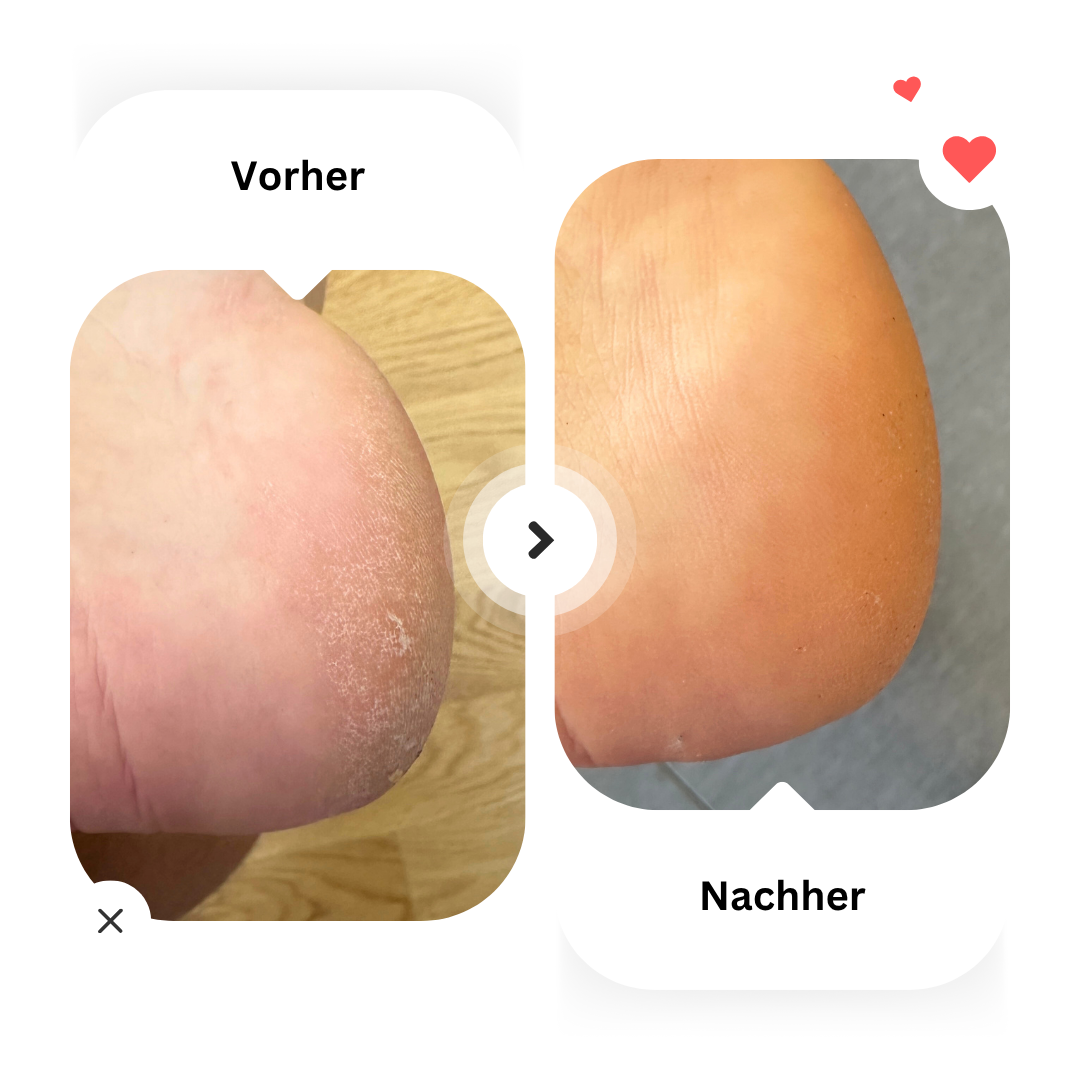 Deutlich glattere Fersen nach regelmäßiger Anwendung der Hydra Pflege-Socken.